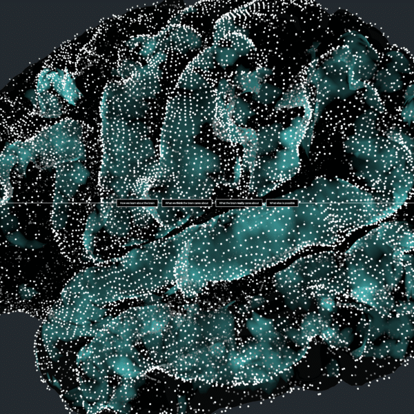Single case study — Brain Cartography for UCSF